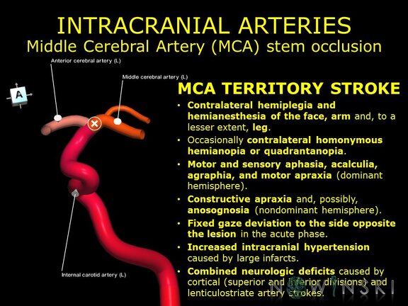 G11.T15.8.VascularDisorders.MiddleCerebralArtery.Middle cerebral artery stem occlusion