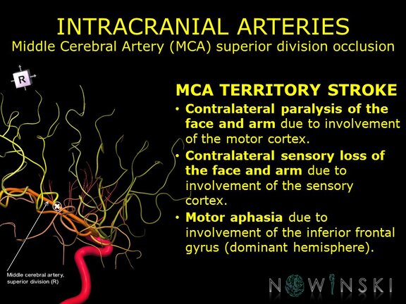 G11.T15.8.VascularDisorders.MiddleCerebralArtery.Middle cerebral artery superior division occlusion
