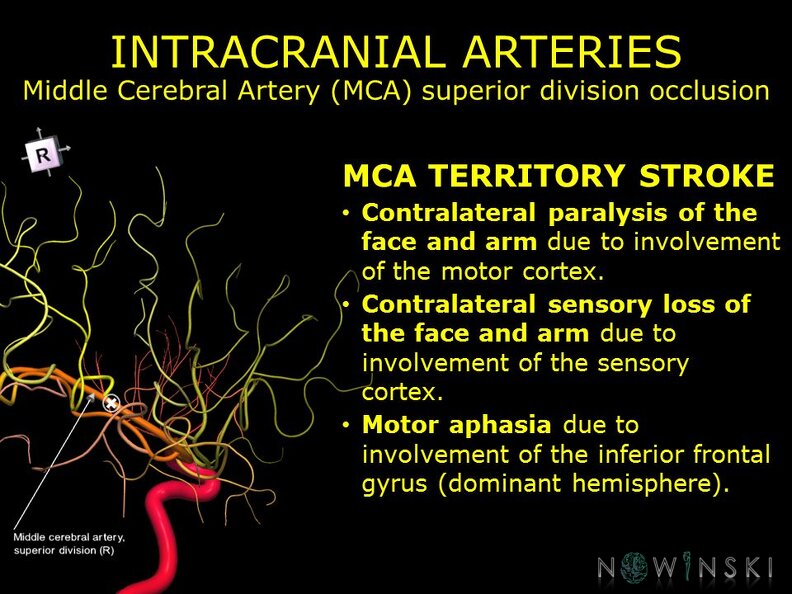 G11.T15.8.VascularDisorders.MiddleCerebralArtery.Middle_cerebral_artery_superior_division_occlusion.TIF
