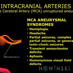 G11.T15.8.VascularDisorders.MiddleCerebralArtery.Middle cerebral artery unruptured aneurysm