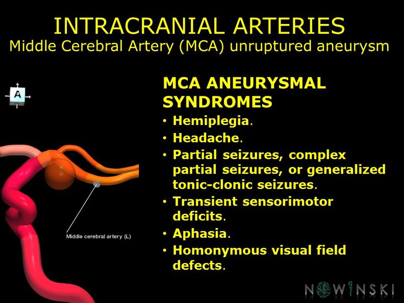 G11.T15.8.VascularDisorders.MiddleCerebralArtery.Middle_cerebral_artery_unruptured_aneurysm.TIF