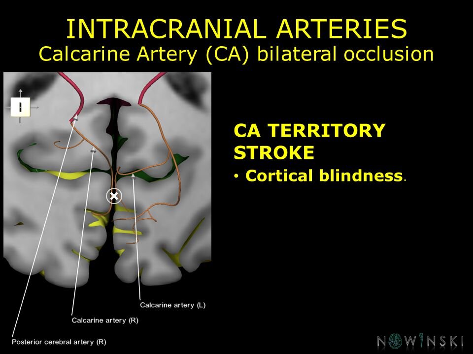 G11.T15.9.VascularDisorders.PosteriorCerebralArtery.Calcarine artery bilateral occlusion