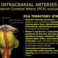 G11.T15.9.VascularDisorders.PosteriorCerebralArtery.Posterior cerebral artery occlusion