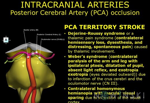 G11.T15.9.VascularDisorders.PosteriorCerebralArtery.Posterior cerebral artery occlusion