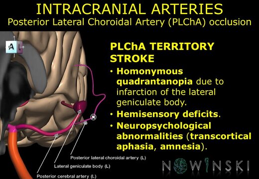G11.T15.9.VascularDisorders.PosteriorCerebralArtery.Posterior lateral choroidal artery occlusion