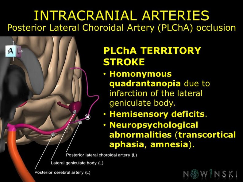 G11.T15.9.VascularDisorders.PosteriorCerebralArtery.Posterior lateral choroidal artery occlusion
