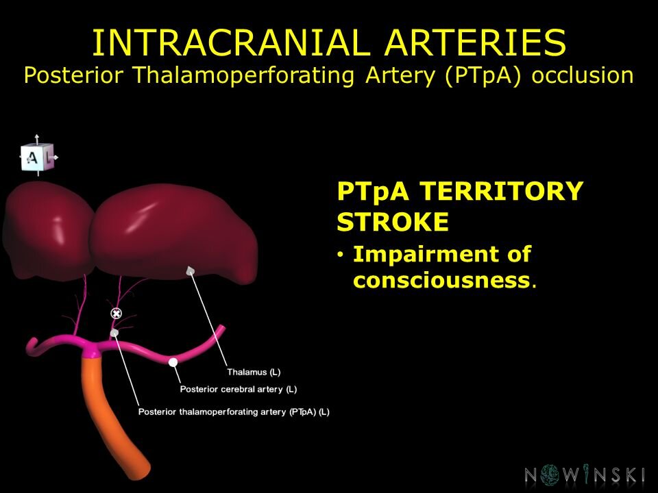 G11.T15.9.VascularDisorders.PosteriorCerebralArtery.Posterior thalamoperforating artery occlusion