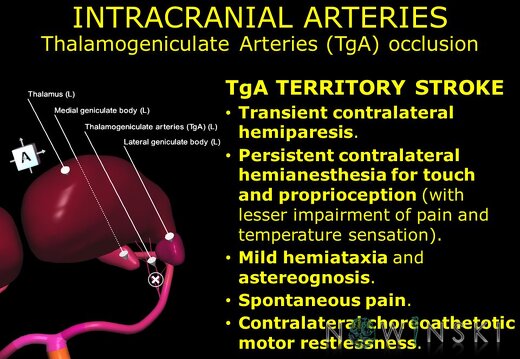 G11.T15.9.VascularDisorders.PosteriorCerebralArtery.Thalamogeniculate arteries occlusion