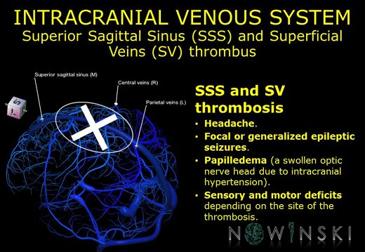 G11.T16.1.VascularDisorders.IntracranialVenousSystem.Superior sagittal sinus superficial veins thrombus