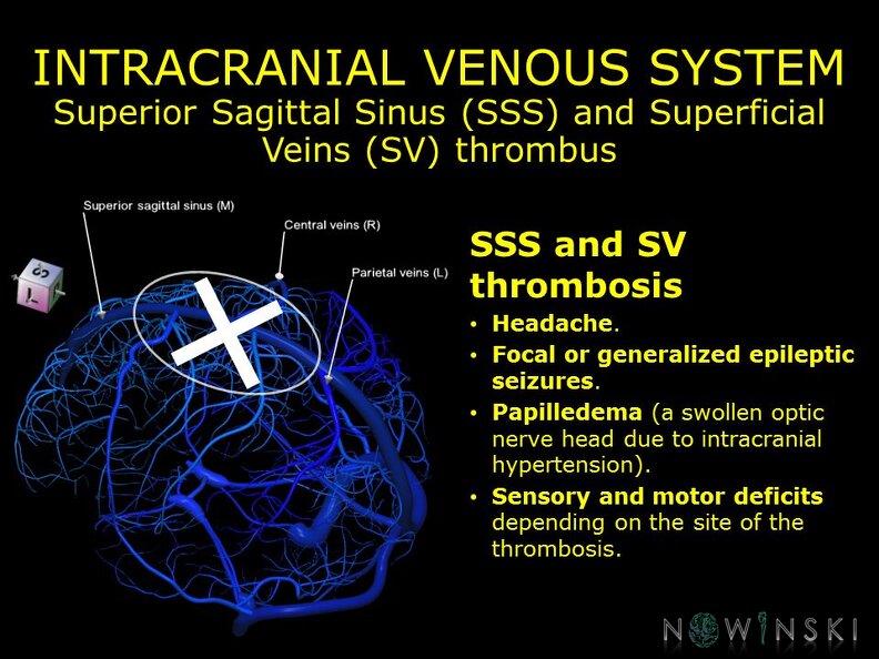 G11.T16.1.VascularDisorders.IntracranialVenousSystem.Superior_sagittal_sinus_superficial_veins_thrombus.TIF