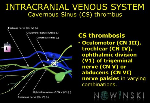 G11.T16.4.VascularDisorders.CavernousSinus.Cavernous sinus thrombus