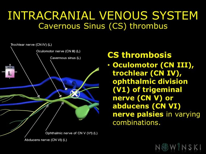 G11.T16.4.VascularDisorders.CavernousSinus.Cavernous sinus thrombus