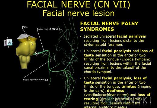 G11.T19.10.CranialNerveDisorders.Facial nerve lesion