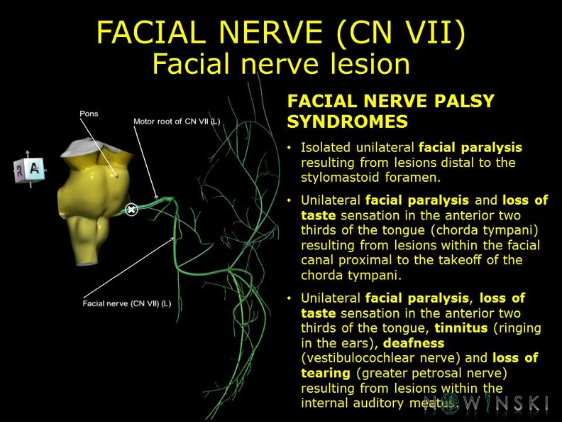G11.T19.10.CranialNerveDisorders.Facial_nerve_lesion.TIF