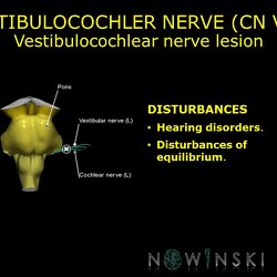 G11.T19.11.CranialNerveDisorders.Vestibulocochlear nerve lesion