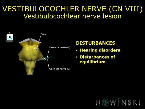 G11.T19.11.CranialNerveDisorders.Vestibulocochlear nerve lesion