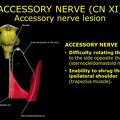 G11.T19.14.CranialNerveDisorders.Accessory nerve lesion