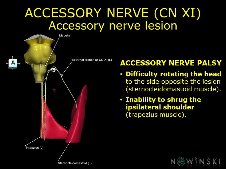 G11.T19.14.CranialNerveDisorders.Accessory_nerve_lesion.TIF