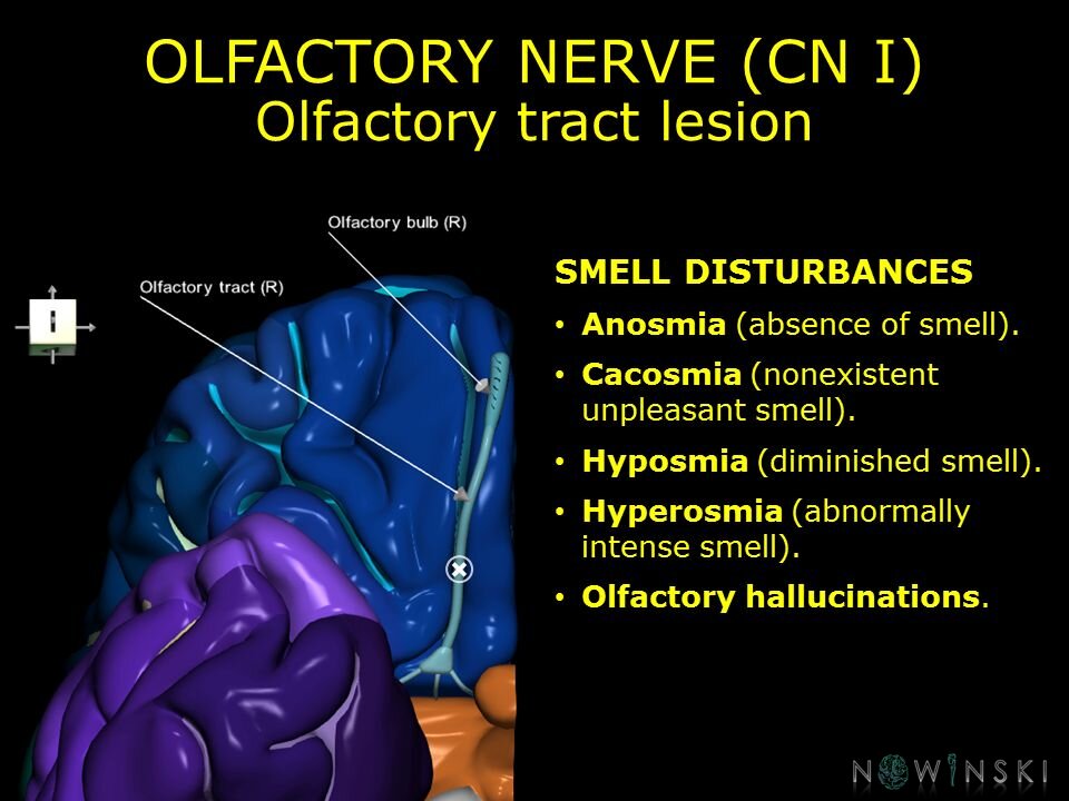 G11.T19.4.CranialNerveDisorders.Olfactory tract lesion