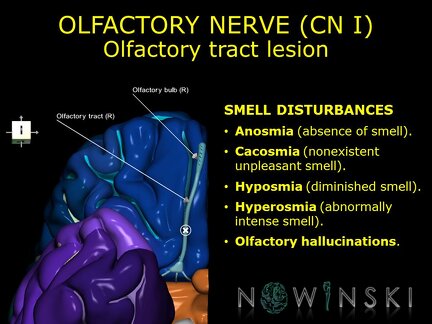 G11.T19.4.CranialNerveDisorders.Olfactory tract lesion