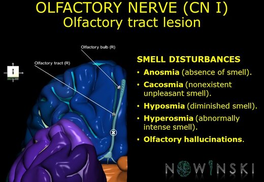 G11.T19.4.CranialNerveDisorders.Olfactory tract lesion