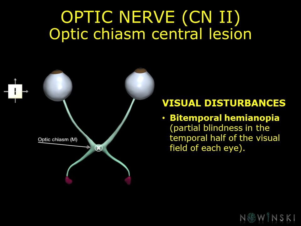 G11.T19.5.CranialNerveDisorders.Optic chiasm central lesion