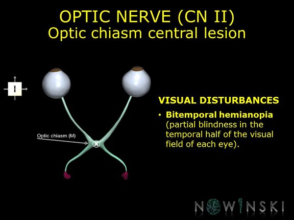 G11.T19.5.CranialNerveDisorders.Optic chiasm central lesion