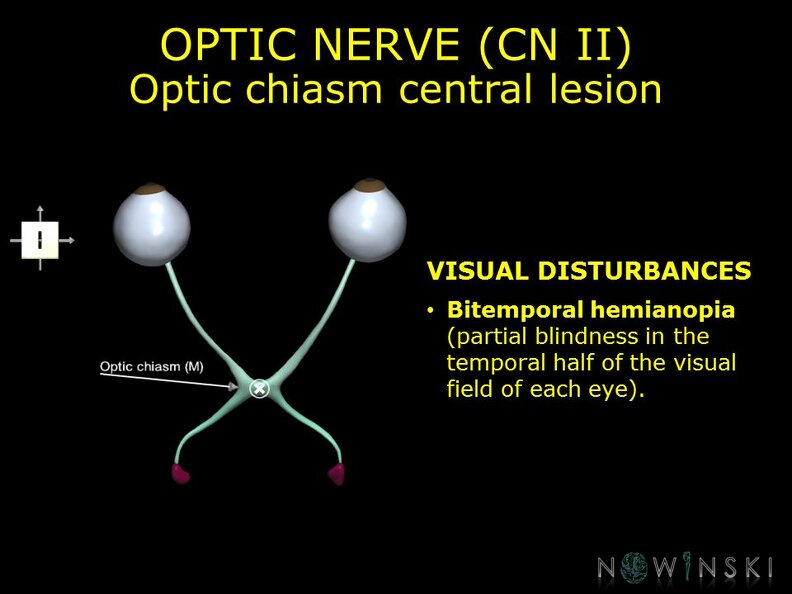 G11.T19.5.CranialNerveDisorders.Optic_chiasm_central_lesion.TIF