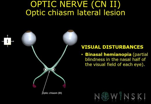 G11.T19.5.CranialNerveDisorders.Optic chiasm lateral lesion
