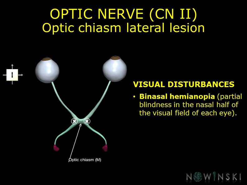 G11.T19.5.CranialNerveDisorders.Optic_chiasm_lateral_lesion.TIF
