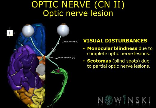 G11.T19.5.CranialNerveDisorders.Optic nerve lesion