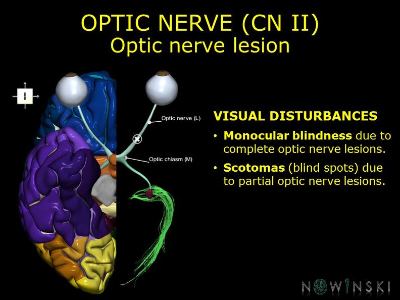 G11.T19.5.CranialNerveDisorders.Optic_nerve_lesion.TIF