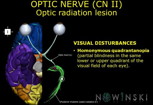G11.T19.5.CranialNerveDisorders.Optic radiation lesion