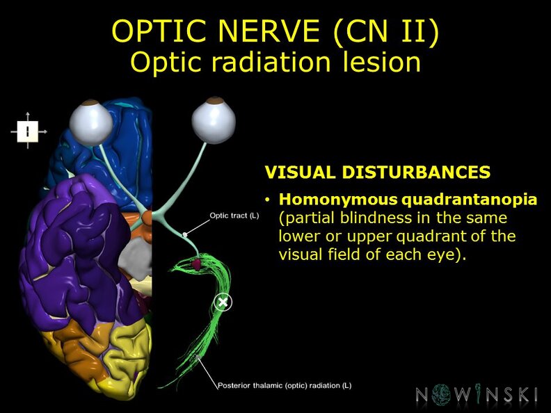 G11.T19.5.CranialNerveDisorders.Optic_radiation_lesion.TIF