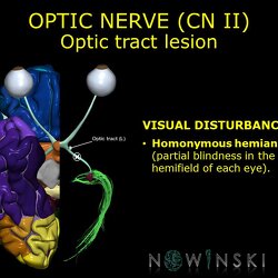 G11.T19.5.CranialNerveDisorders.Optic tract lesion