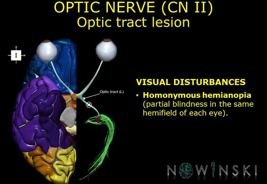 G11.T19.5.CranialNerveDisorders.Optic tract lesion