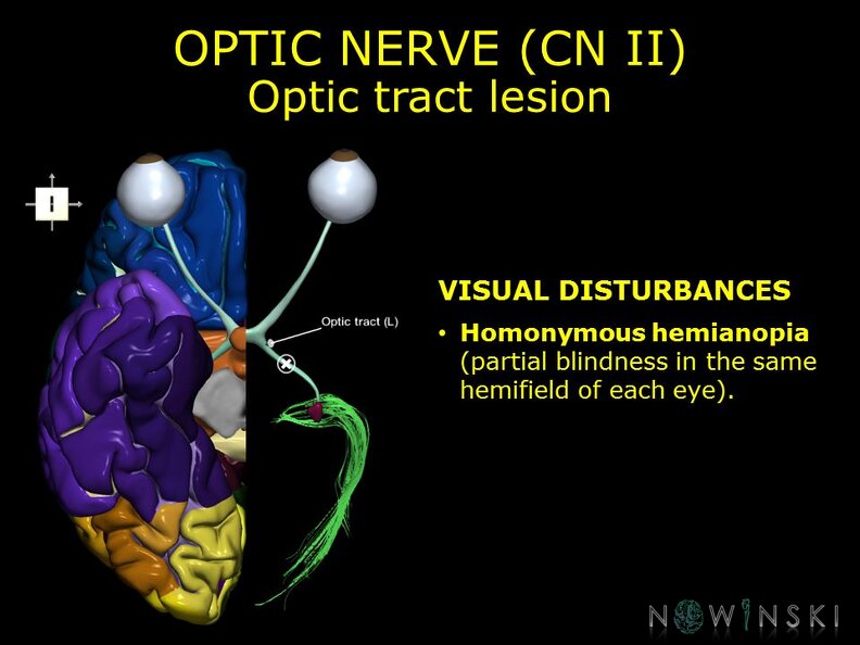 G11.T19.5.CranialNerveDisorders.Optic_tract_lesion.TIF