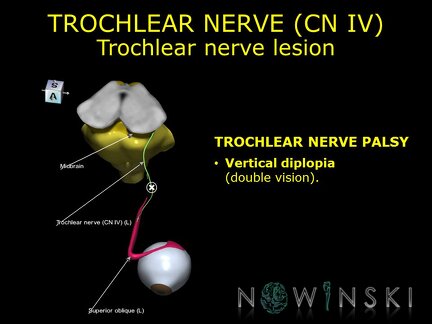 G11.T19.7.CranialNerveDisorders.Trochlear nerve lesion