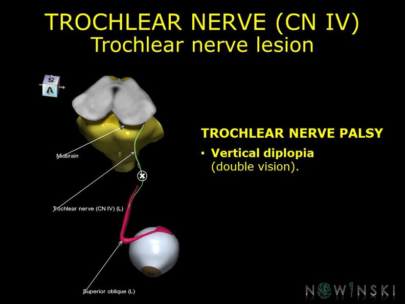 G11.T19.7.CranialNerveDisorders.Trochlear nerve lesion