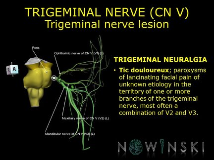 G11.T19.8.CranialNerveDisorders.Trigeminal nerve lesion