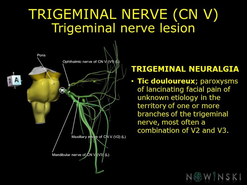 G11.T19.8.CranialNerveDisorders.Trigeminal nerve lesion
