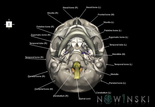 G2.T1-22.V6.C2.L1.CNS–Skull