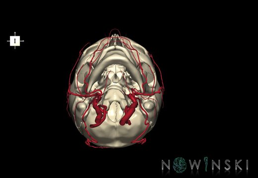 G2.T17.2-22.1.V6.C1.L0.Extracranial arteries all–Skull whole