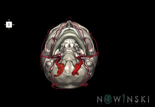 G2.T17.2-22.1.V6.C2.L0.Extracranial arteries all–Skull whole