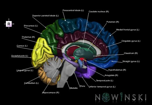 G2.T2.2-11.V4.C3-2.L1-.Brain left–Deep nuclei right