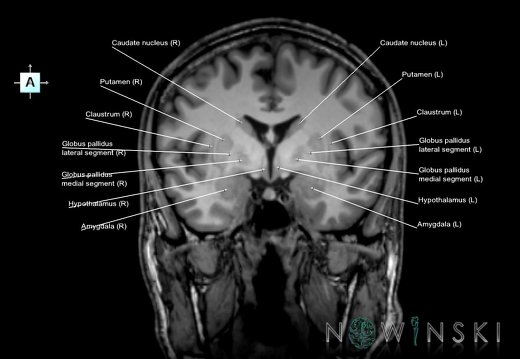 G6.T11.1.V1.P-04.Deep nuclei all–Triplanar