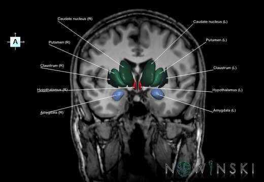 G6.T11.1.V1.P-04S.Deep nuclei all–Triplanar