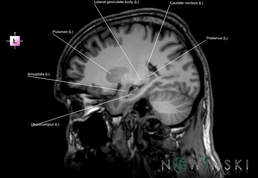 G6.T11.1.V2.P24.Deep nuclei all–Triplanar