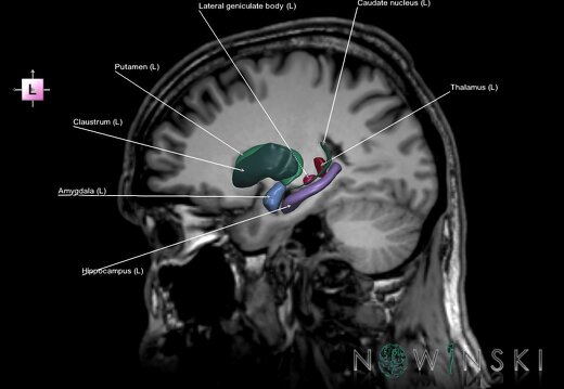 G6.T11.1.V2.P24S.Deep nuclei all–Triplanar