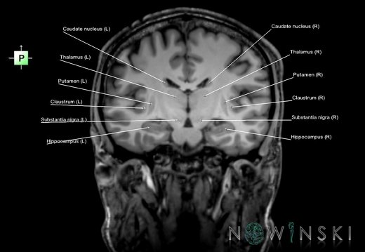 G6.T11.1.V3.P-17.Deep nuclei all–Triplanar